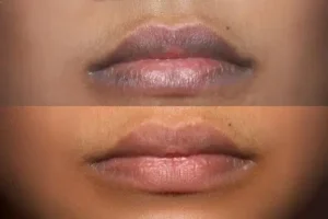 How_to_Get_Rid_of_Darkness_Around_Lip_Corners_Instant