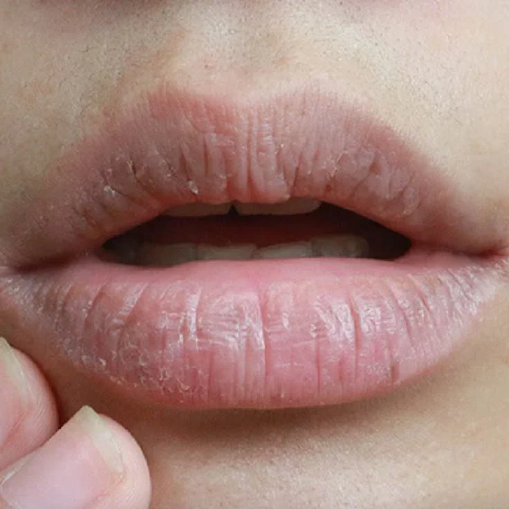 Symptoms of Dry Lips