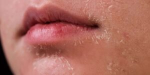 symtoms of dry skin