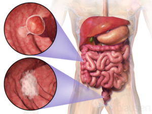 What Is Colorectal Cancer